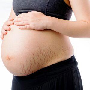 Pregnant woman with stretch marks
