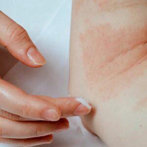 Eczema – the truth (Part 1 of 2)
