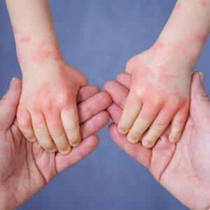 Eczema – the truth (Part 2 of 2)
